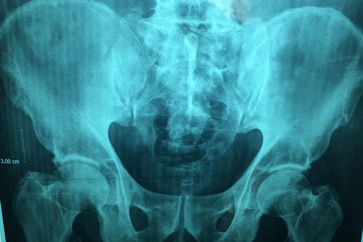 Radiografia da pelve em incidência frontal, exame usado para avaliar a cobertura da cabeça do fêmur pelo acetábulo